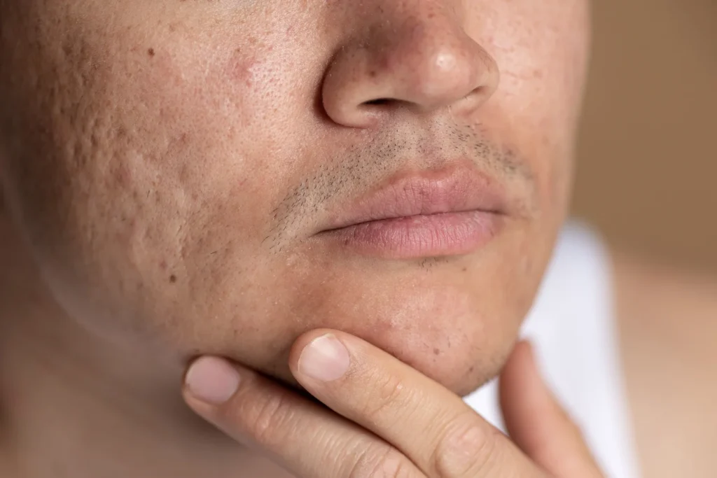 Acne Scar