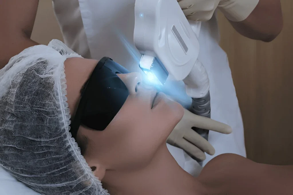 IPL Photofacial4