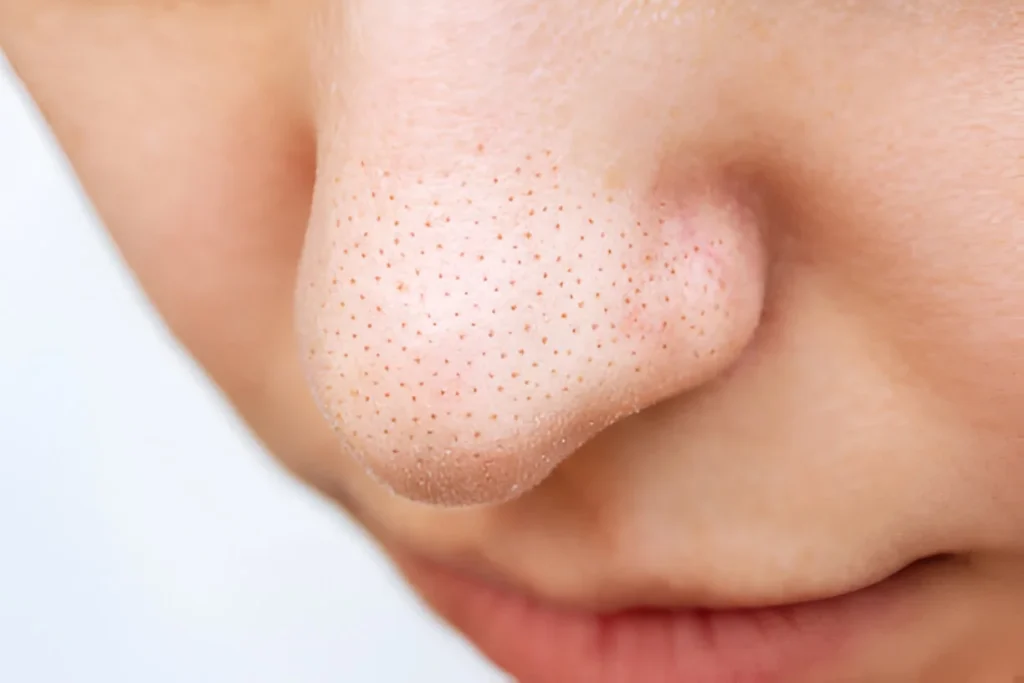 Open Pores