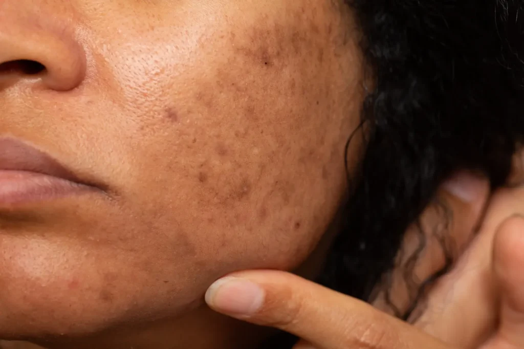 melasma